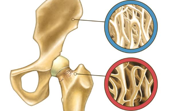 osteopenija