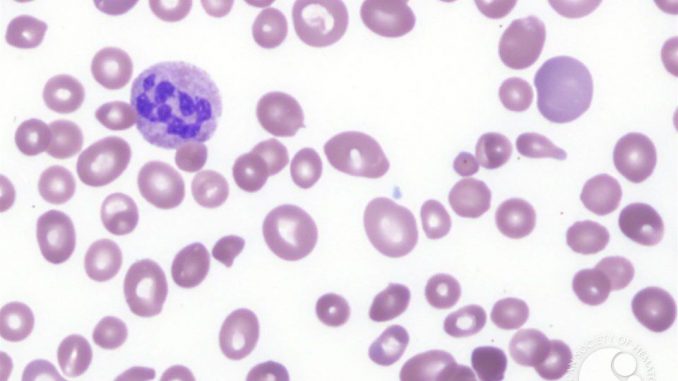 megaloblasticna-anemija