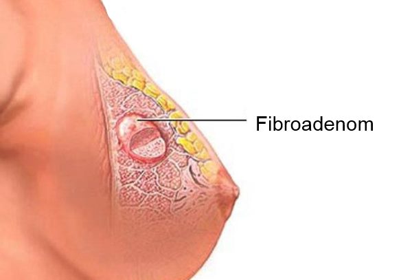 fibroadenom dojke