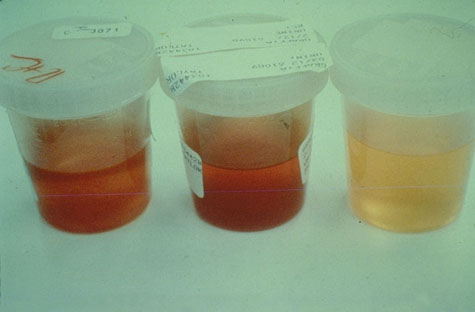hemoglobin u urinu