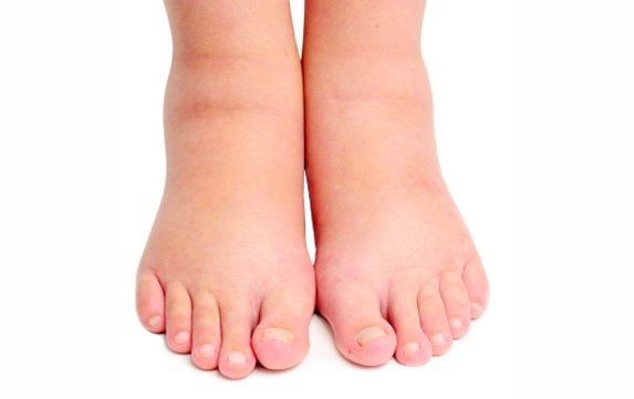 Uobičajeni uzroci oticanja noge ili preopterećenja tekućine