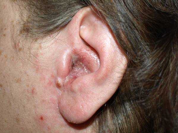 otitis eksterna