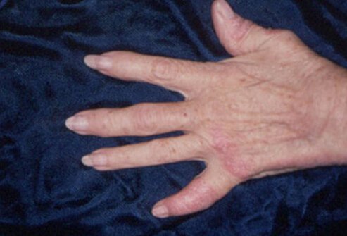 psorijaticni artritis simptomi