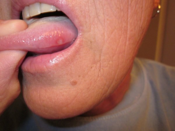 rak jezika prvi simptomi