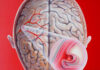 aneurizma u mozgu