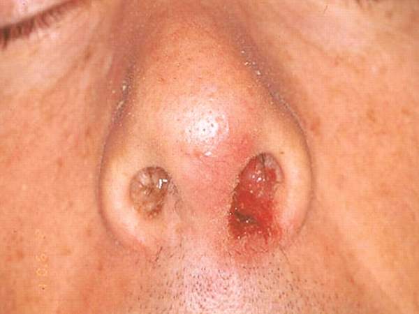bakterija stafilokoka u nosu