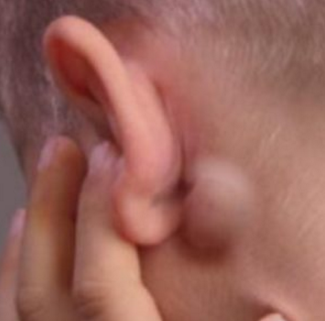 bol u ramenskom zglobu koji se proteže iza uha