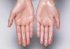 znojenje dlanova uzrok