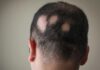 alopecija areata